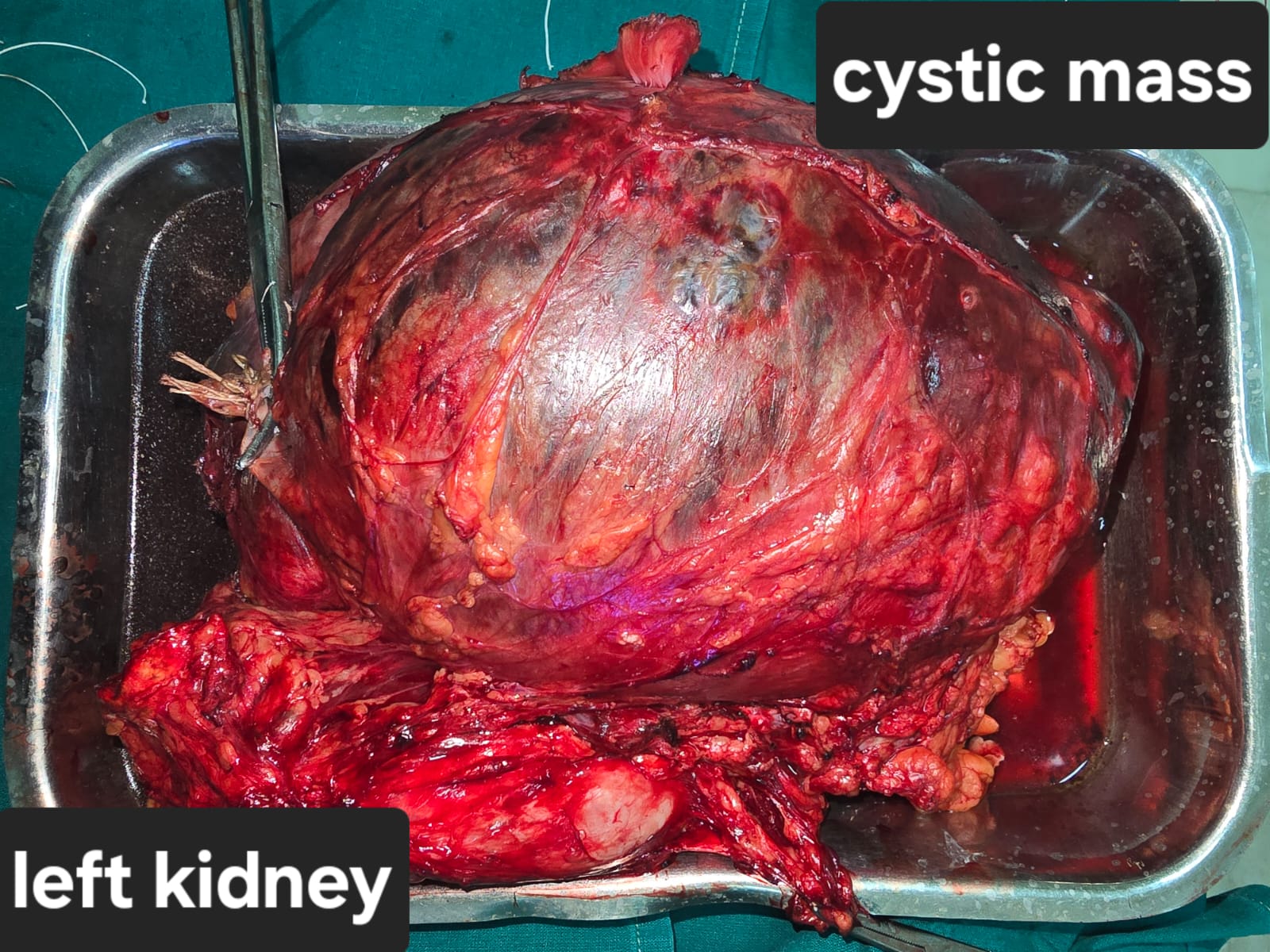 Complicated Case Done At SSGCH